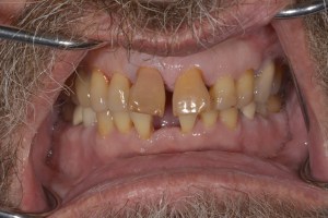 Upclose image of a mouth before dental implant