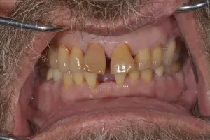 Upclose image of a mouth before dental implant