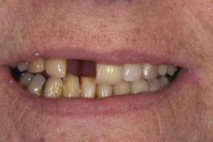 Smile Gallery Before