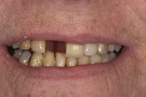 Smile Gallery Before