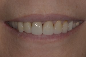 Smile Gallery After