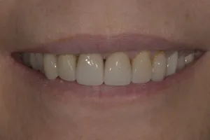 Smile Gallery After