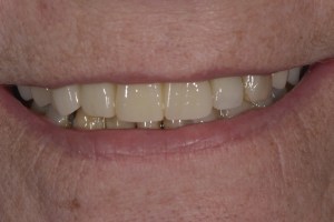 Smile Gallery After