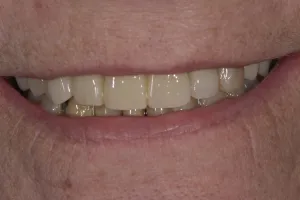 Smile Gallery After