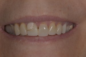 Smile Gallery Before