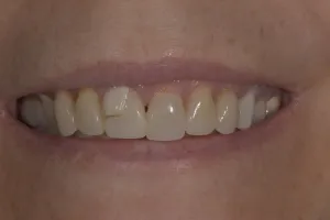 Smile Gallery Before
