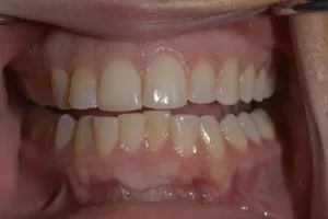 Smile Gallery Before
