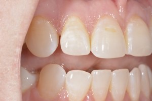 Smile Gallery Before