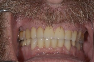 Upclose image of a mouth before dental implant
