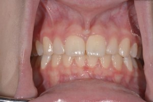 Smile Gallery After