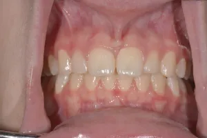 Smile Gallery After