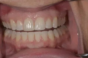 Smile Gallery After