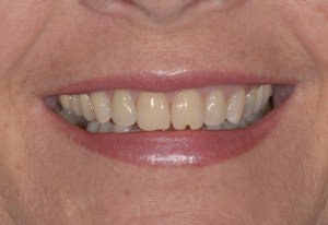 Smile Gallery Before