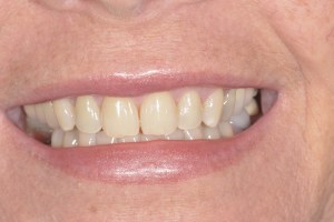 Smile Gallery After