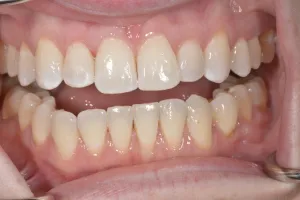 Smile Gallery After