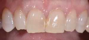 Smile Gallery Before