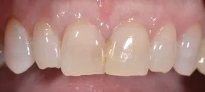 Smile Gallery Before
