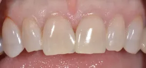Smile Gallery After