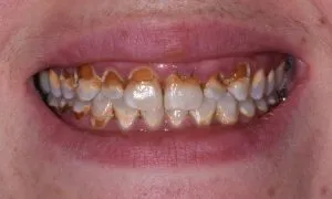 Upclose image of a mouth before dental implant