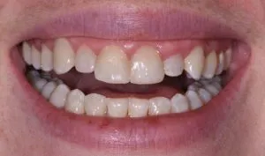 Upclose image of a mouth after dental implant