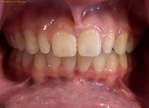 Smile Gallery Before
