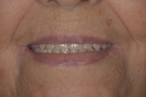 After image of a mouth after dental restoration