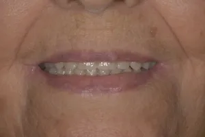 After image of a mouth after dental restoration