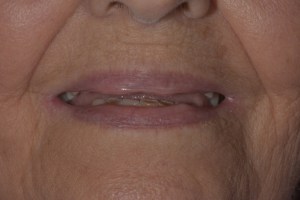 Before image of a mouth missing upper and lower teeth