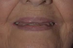 Before image of a mouth missing upper and lower teeth