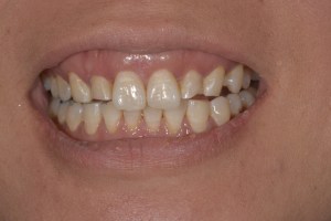 Upclose image of a mouth before dental implant