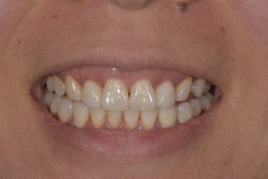 Upclose image of a mouth after dental implant