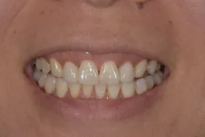 Upclose image of a mouth after dental implant