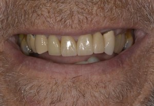 After procedure, straight white teeth.
