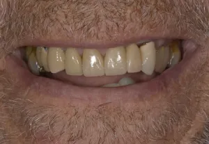 After procedure, straight white teeth.