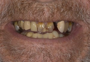 Before operating on broken, crooked, discolored teeth