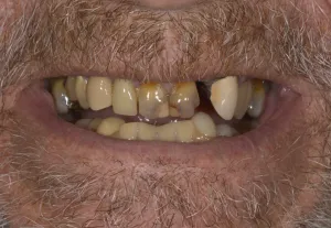 Before operating on broken, crooked, discolored teeth