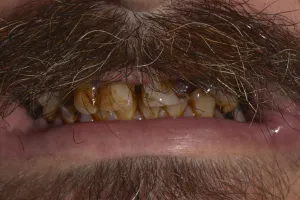 Before operating on broken, crooked, discolored teeth