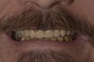 After procedure, full upper denture.